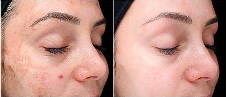 Breakout after chemical peel